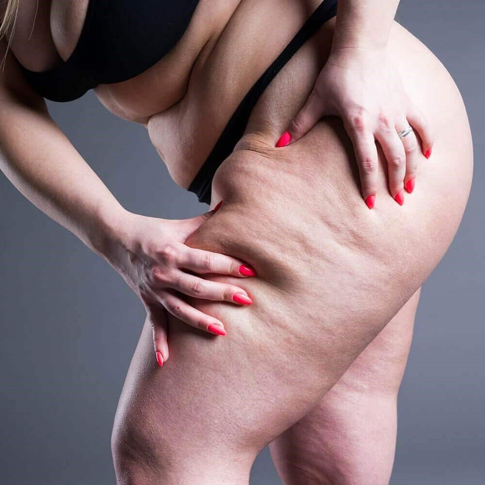 Lipedema Stages